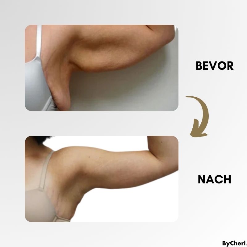 LymphWave™ - Bekämpfen Sie hartnäckiges Fett mit lymphatischer Stimulation